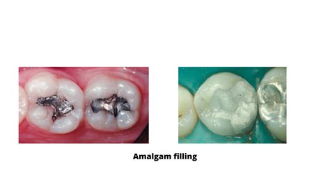 AmalgamChi non si informa adeguatamente in anticipo corre il rischio di ricevere amalgam che non hanno la funzione desiderata o sono realizzati con materiali di qualità inferiore. Se volete un prodotto che soddisfi al meglio le vostre aspettative, dovreste provare un amalgam.
  <p>Per i prodotti si possono trovare test online e confronti tra i prodotti.  I confronti tra i prodotti possono aiutare a confrontare le diverse funzioni o proprietà dei diversi prodotti. Di seguito, spieghiamo perché la ricerca è importante e di cosa si dovrebbe essere consapevoli quando si acquista un articolo.
</p>

<h2>Acquisto di Amalgam - criteri importanti</h2>

<p>Una lista di controllo può aiutarti a evitare di dover cercare informazioni sui prodotti su decine di siti web. Di seguito è riportato un esempio di una lista di controllo che può aiutarvi a trovare il prodotto giusto. Importanti criteri di acquisto includono, ad esempio:
</p><ul>
<li>Opinioni dei clienti</li>
<li>Confronti dei prezzi</li>
<li>Dettagli del prodotto</li>
<li>Termini e condizioni di consegna</li>
<li>Domande dei clienti e risposte dei marchi</li>
</ul>
<h2>Qual è l